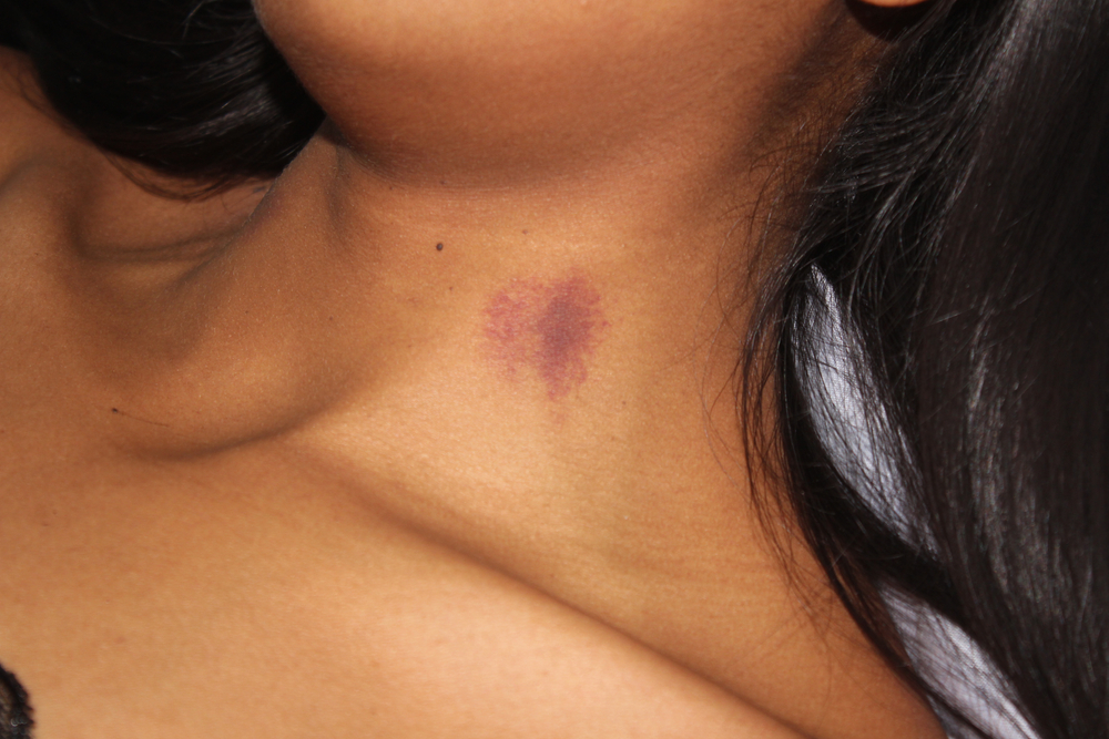 Hickeys and iron deficiency 